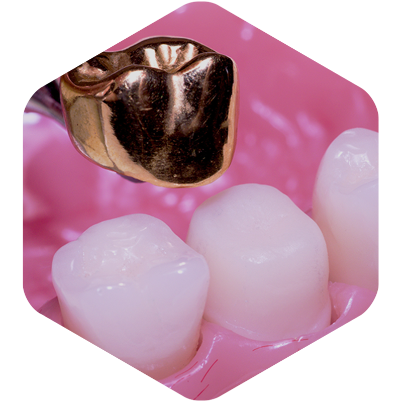 Illustration of gold implant